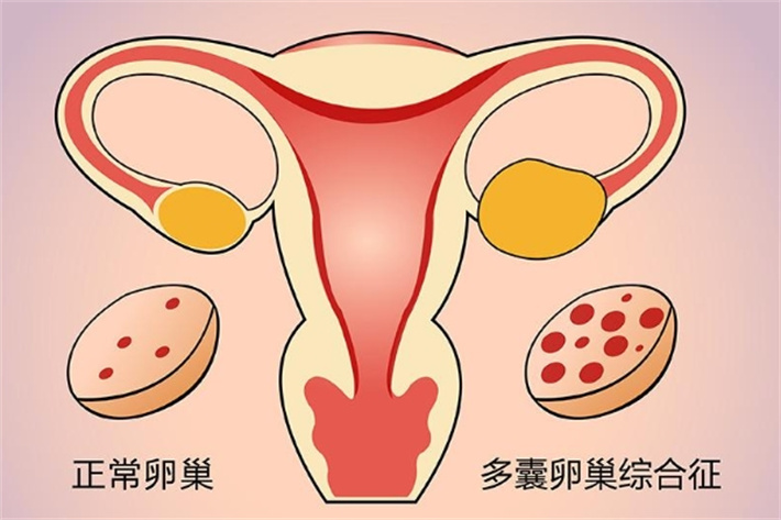 多囊卵巢综合症