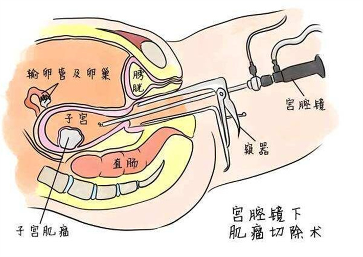 子宫肌瘤切除.jpg