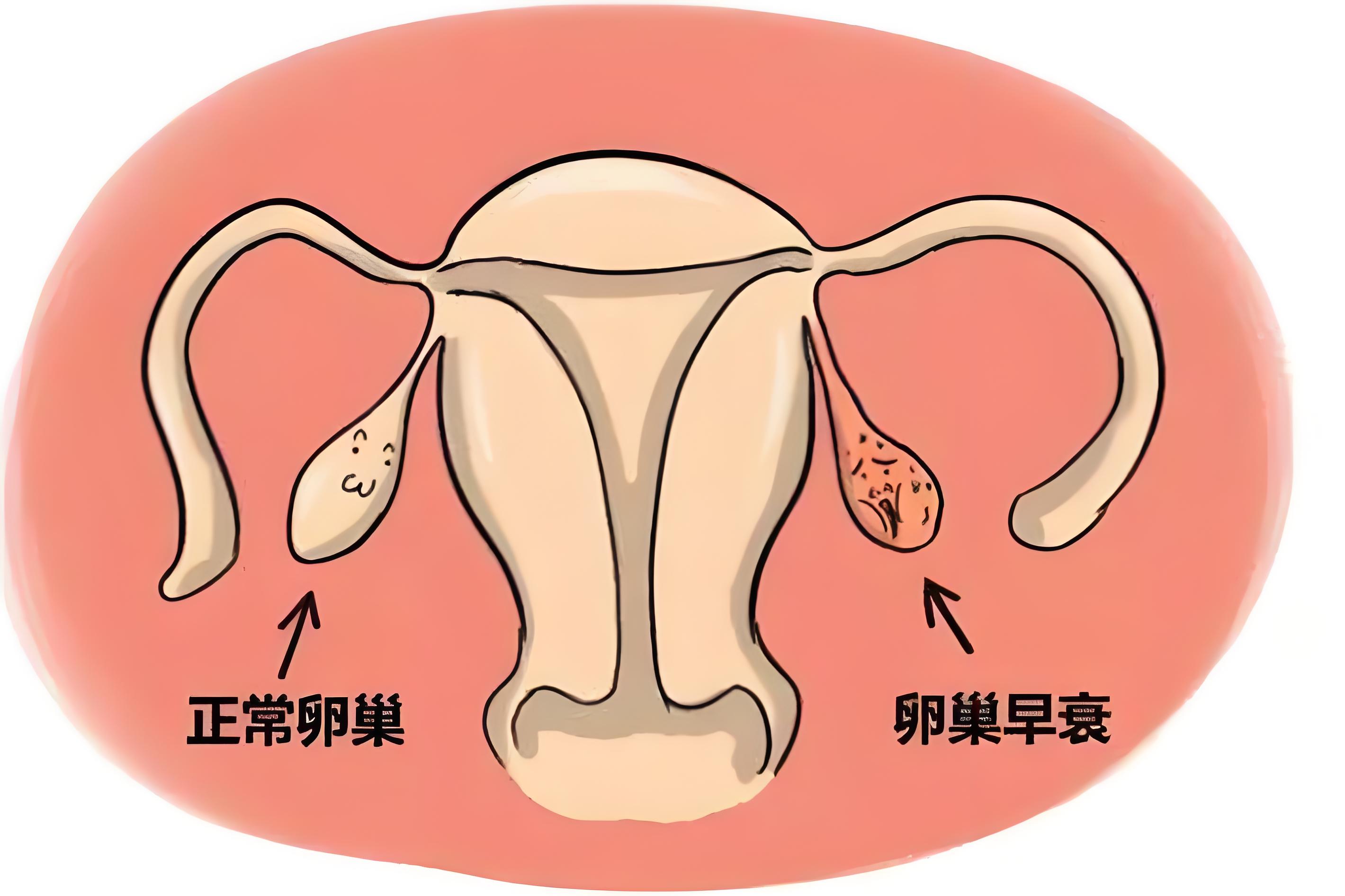 卵巢早衰