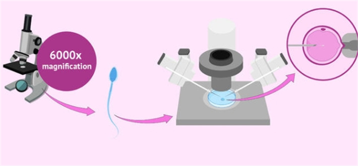 单精子注射技术