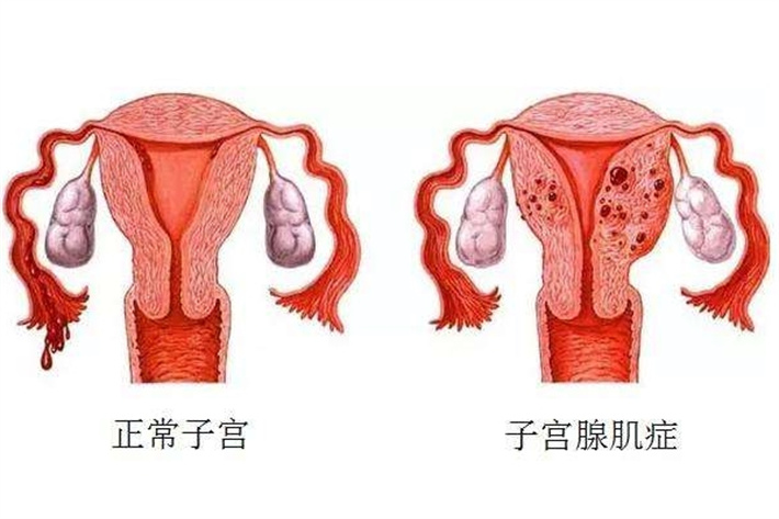 子宫腺肌症