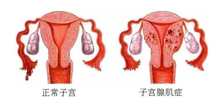 子宫肌腺症