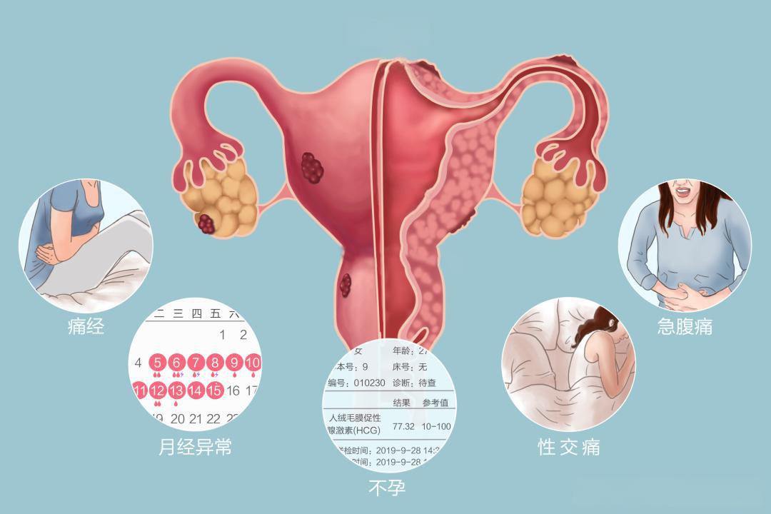 子宫内膜异位症