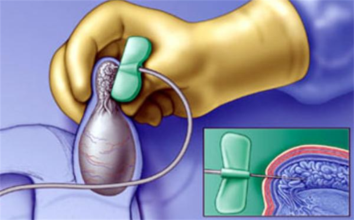 睾丸穿刺取精