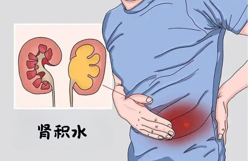 肾积水