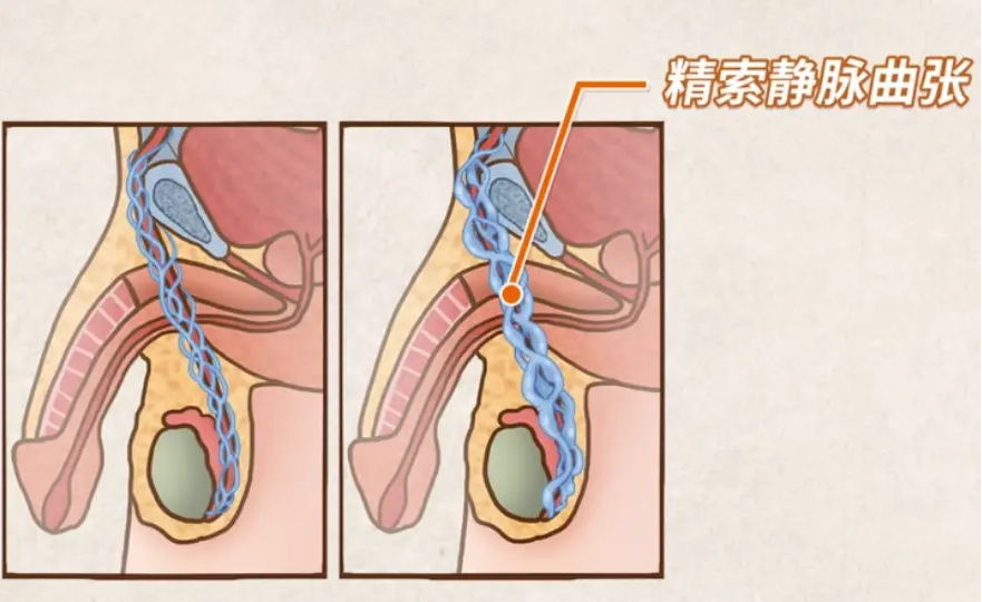 精索静脉曲张