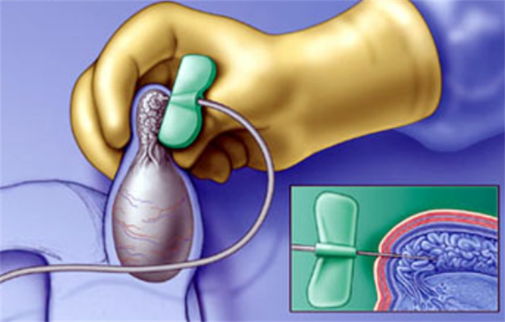 睾丸穿刺取精